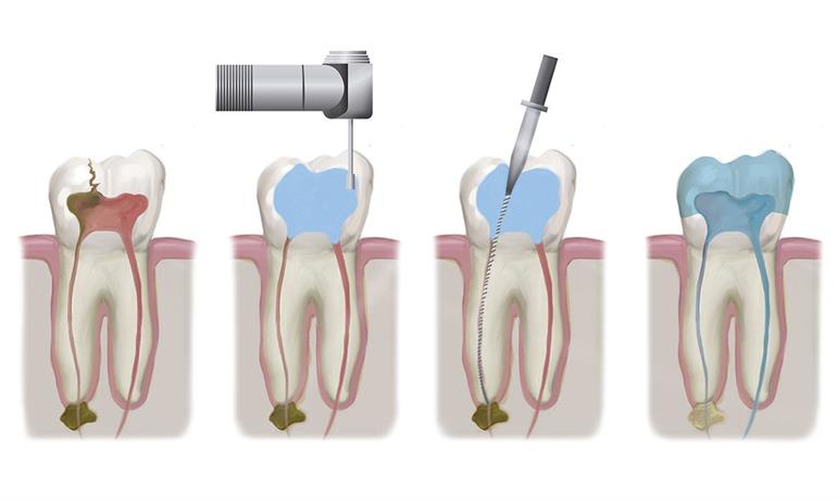 مراحل هشت گانه عصب کشی دندان